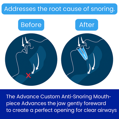 Advance Custom Anti-Snoring Mouthpiece™ - Nestsura